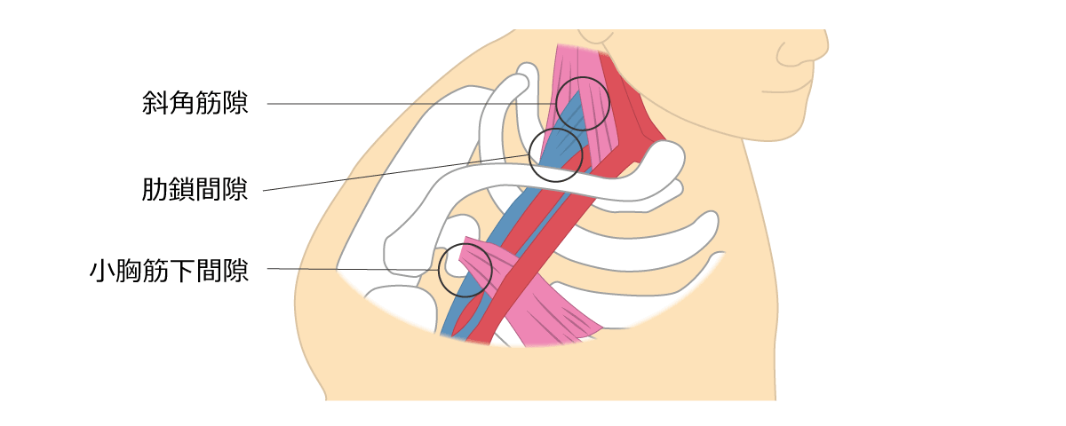 福岡市 胸郭出口症候群治療