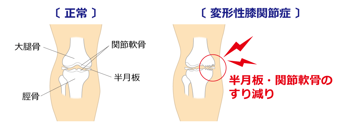福岡市 変形性膝関節症治療