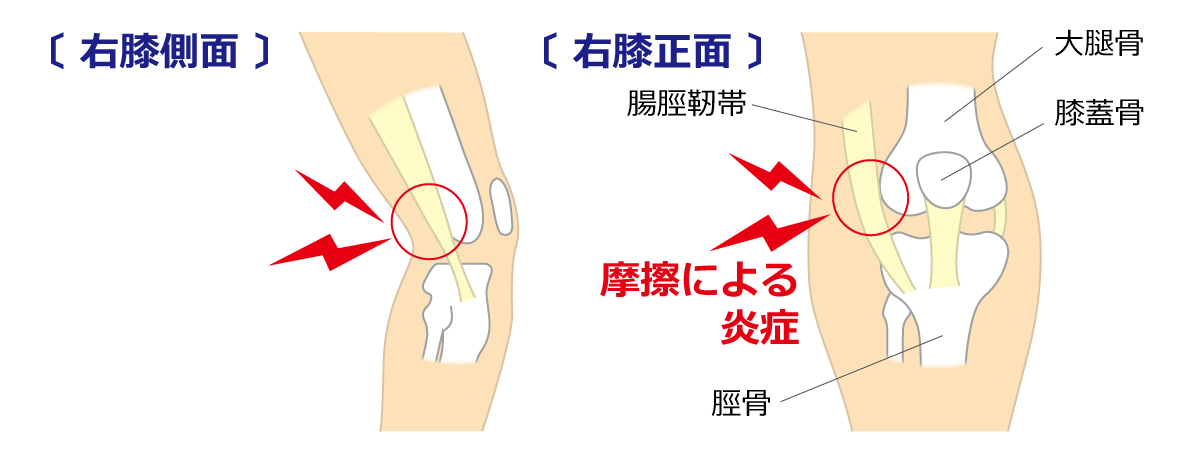 福岡市 腸脛靱帯炎治療