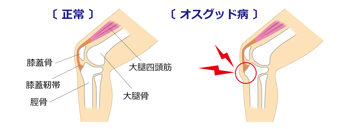 福岡市 オスグッド治療