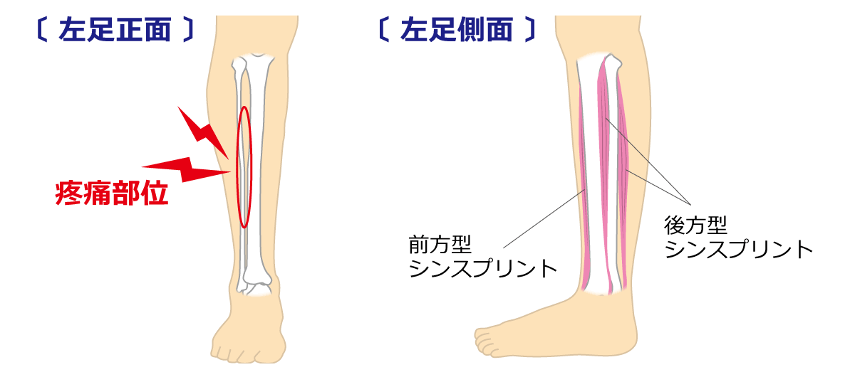 福岡市 シンスプリント治療