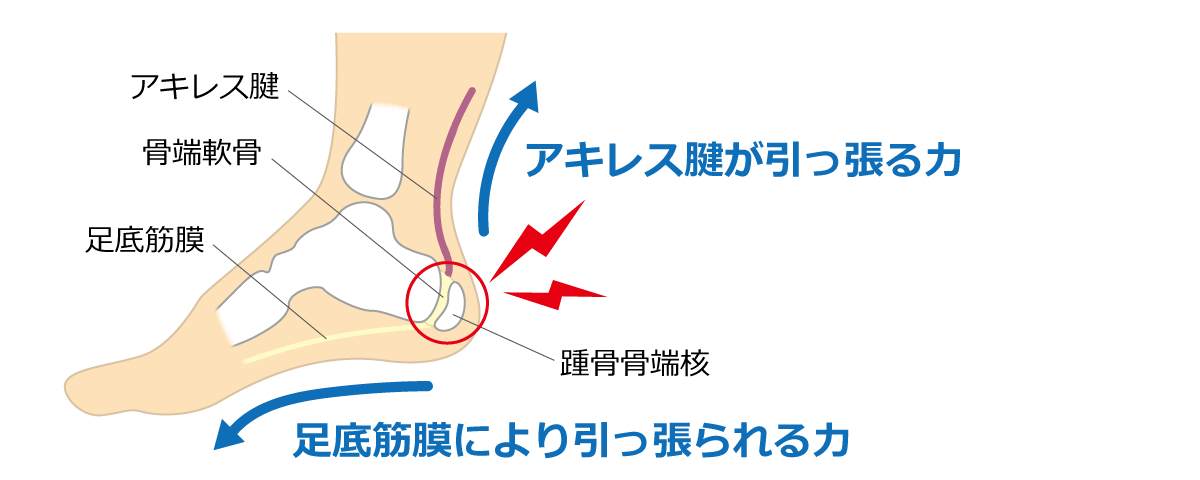 福岡市 セーバー病治療