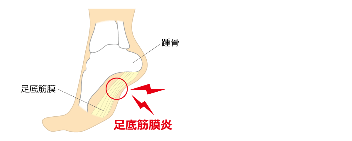 福岡市 足底筋膜炎治療