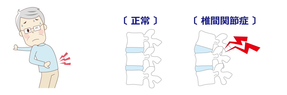 福岡市腰痛治療 椎間関節症