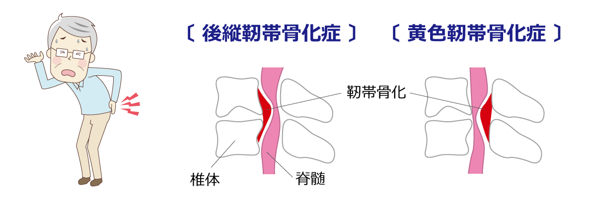 福岡市腰痛治療 後縦靭帯骨化症・黄色靭帯骨化症