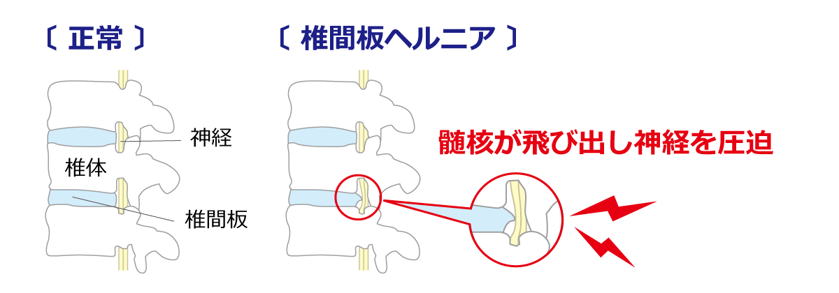 福岡市 腰椎椎間板ヘルニア治療