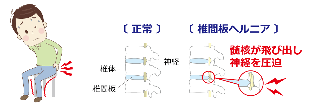 福岡市腰痛治療 椎間板ヘルニア