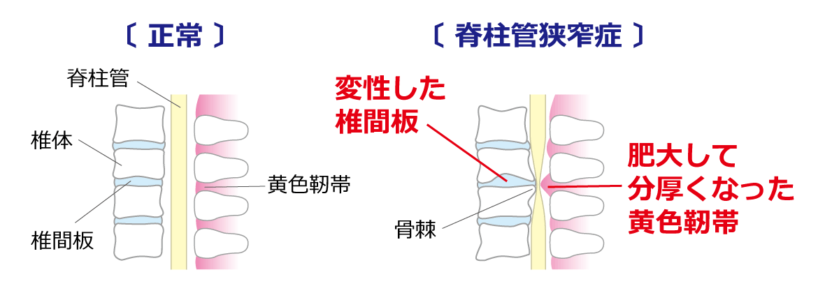 福岡市 脊柱管狭窄症 原因