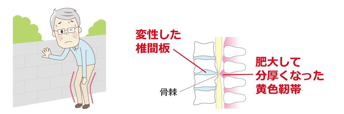 福岡市腰痛治療 脊柱管狭窄症