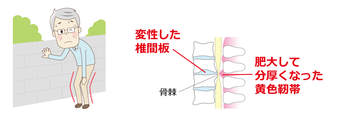 福岡市脊柱管狭窄症治療