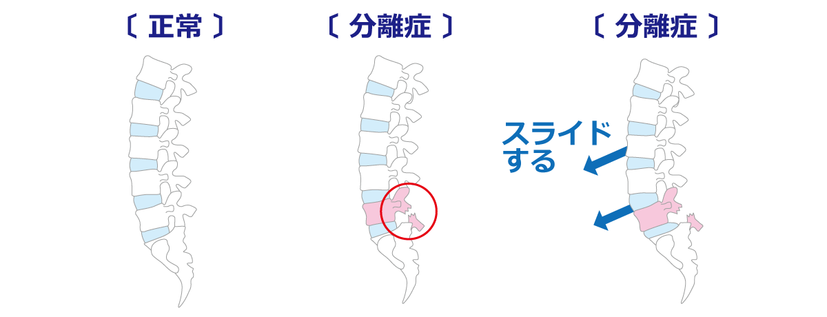 福岡市腰椎分離症 原因