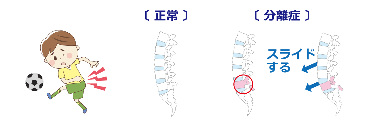 福岡市腰痛治療 腰椎分離症