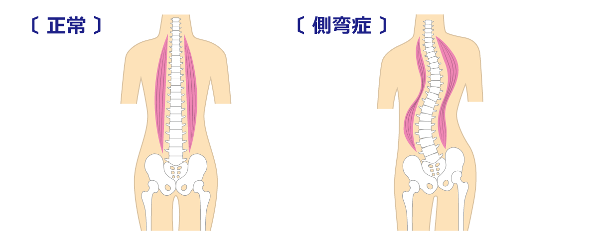 福岡市 側弯症 症状