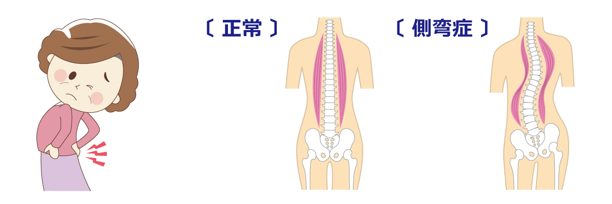 福岡市腰痛治療 側弯症