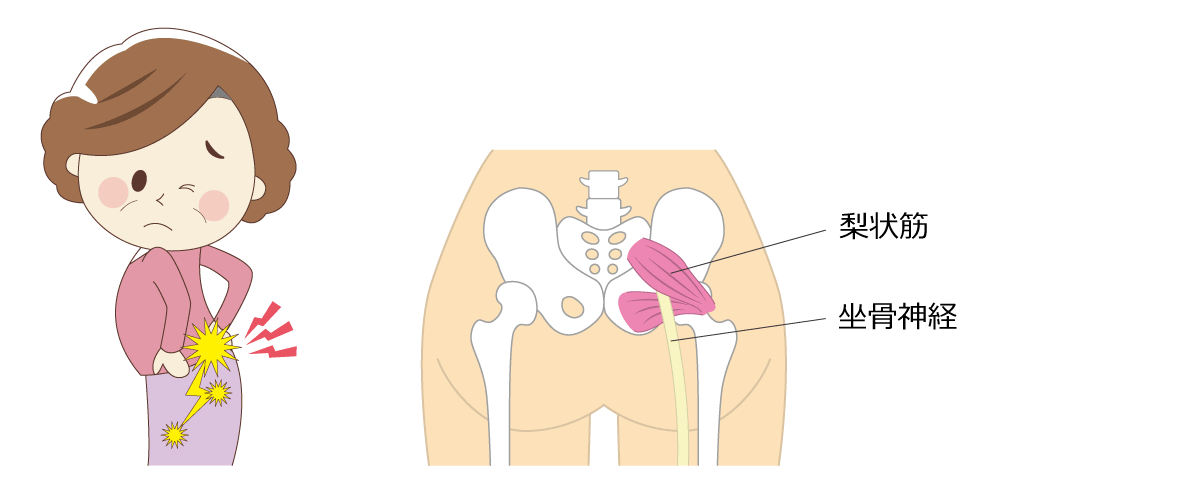 福岡市腰痛治療 坐骨神経痛
